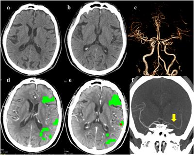 Case report: Ultrasound-Assisted endovascular therapy for carotid artery floating thrombus